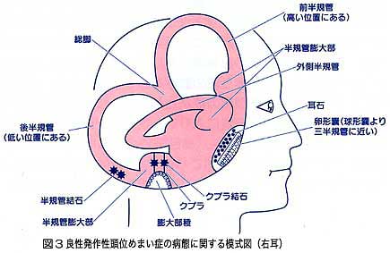 治し 耳 方 めまい 石 良性発作性頭位めまい症（BPPV）の治療：エプリー法と薬